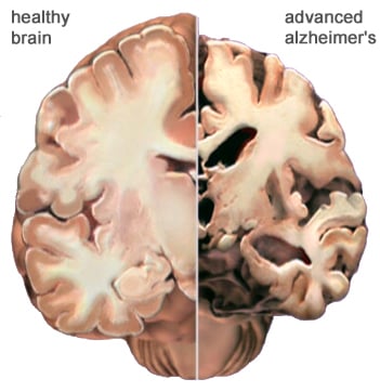 Imagen de cerebro con Alzheimer