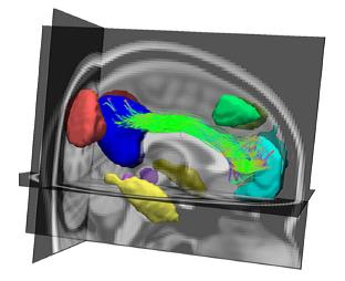 This image shows BrainCAT  linking functional MRI data with connectivity data (diffusion tensor imaging). From: Marques et al. Front. Hum. Neurosci. 7: 794