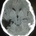 A CT of the head years after a traumatic brain injury showing an empty space marked by the arrow were the damage occurred.