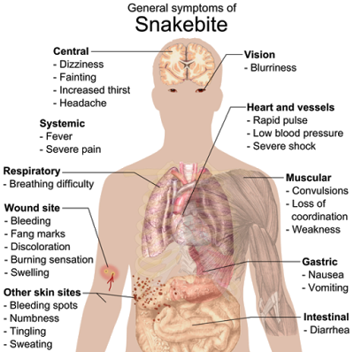 Common symptoms of any kind of snake bite poisoning (Photo credit: Wikipedia) 