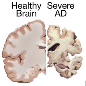 Accumulations of beta-amyloid protein is thought to be the main culprit in death of neurons in AD. Image courtesy of National Institute on Aging, via Wikimedia Commons