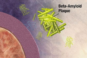 Beta-amyloid is a sticky protein that forms plaques in the brain. Image courtesy of National Institute on Aging, via Wikimedia Commons