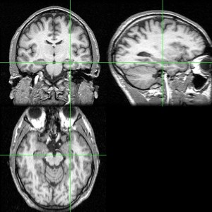 Human hippocampus MRI in 3 different planes (marked by green cross)