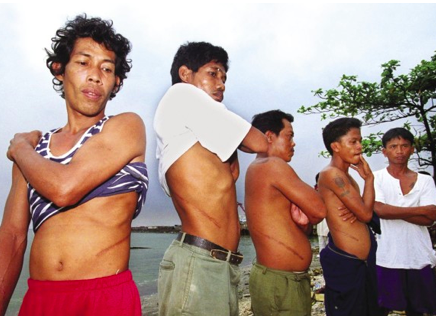 Group of men from Baseco “Kidney-ville” in Philippines, displaying their scars from selling a kidney. 