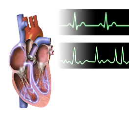 Top: Normal heart activity. Bottom: Heart fibrillation